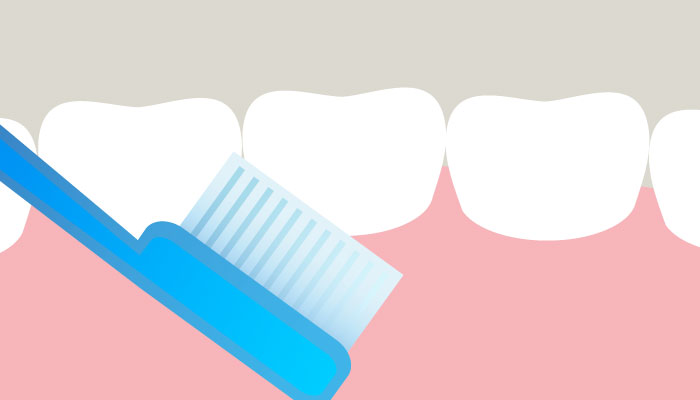 Periimplantitis f Periimplantitis f