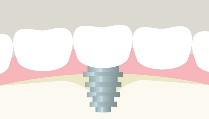 Periimplantitis f Periimplantitis f