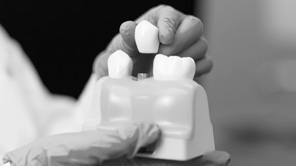 Implantes dentales byn
