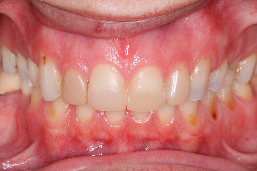 Before-Caso clínico - carillas dentales