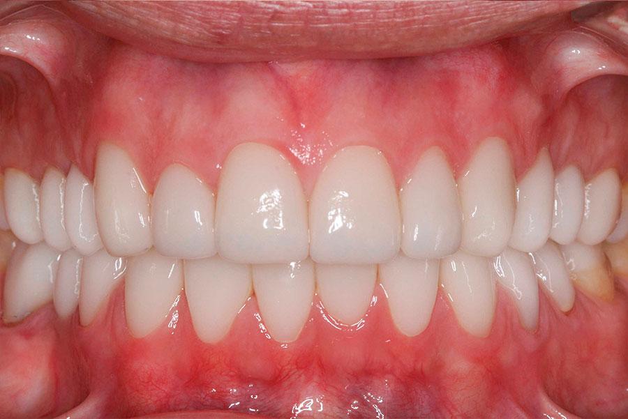 After-Caso clínico - carillas dentales
