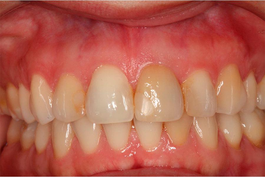 Before-Caso clínico - blanqueamiento dental