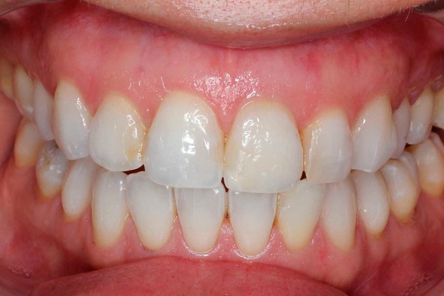 After-Caso clínico - blanqueamiento dental