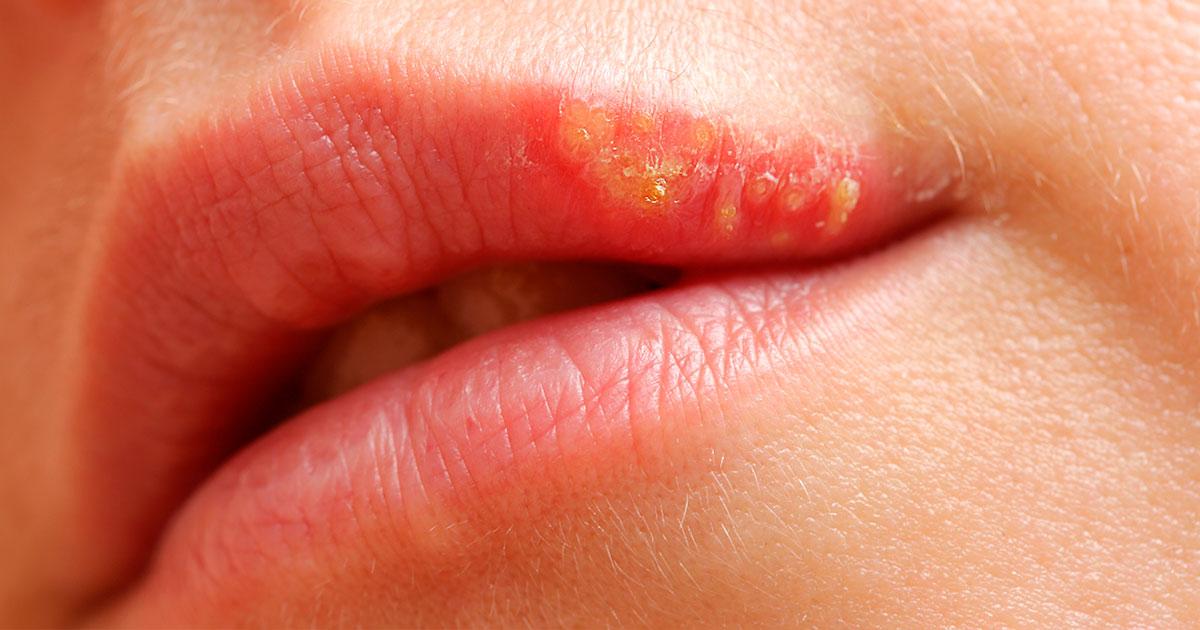 https://clinicaenrile.es/wp-content/uploads/2023/02/herpes-labial.jpg?utm_source=chatgpt.com