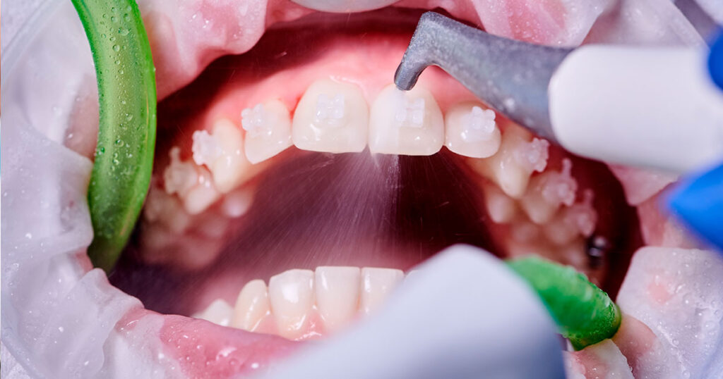 Profilaxis dental